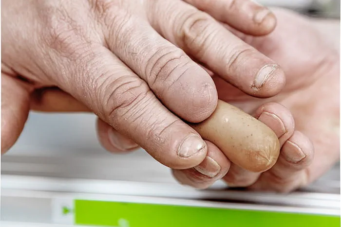 Der Handwerker Johannes Feldhoff mit einer Schnittverletzung